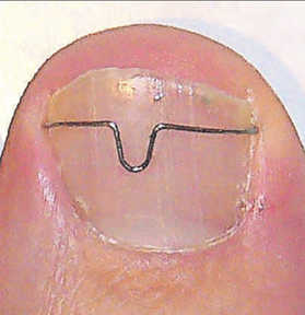 nagelkorrekturspange1